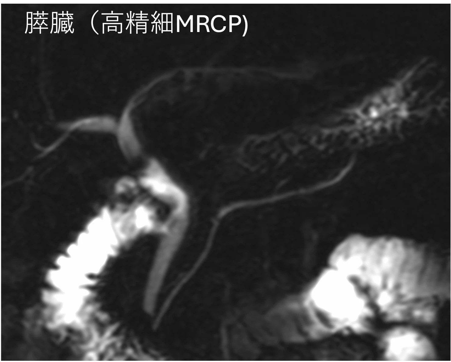 膵臓（高精細MRCP）
